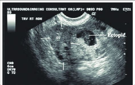 transvaginal ultrasound pregnancy my xxx hot girl