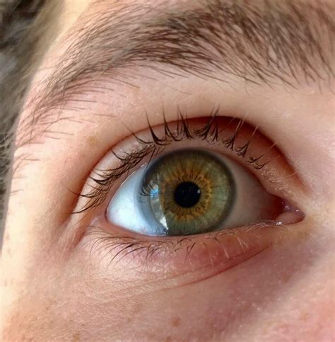 Are Hazel Eyes Heterochromia