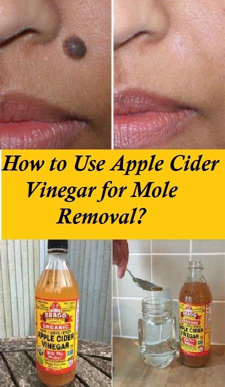 How To Use Apple Cider Vinegar For Mole Removal Health And Beauty