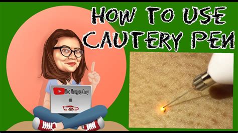 How To Use Cautery Pen Mole And Wart Removal Pen Docmenggay Youtube