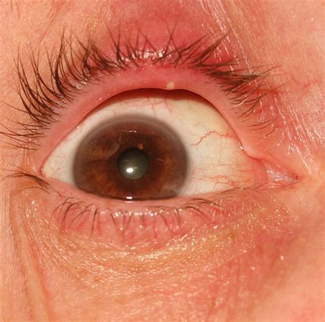 Pimple like bumps with hard white ball centers? Pimple on Eyelid: Causes & Getting Rid of Small Bumps ...