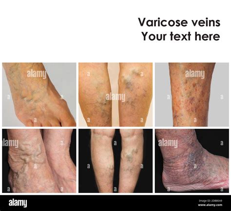 The Collage From Images Of Varicose Veins On A Legs Of Old Woman And