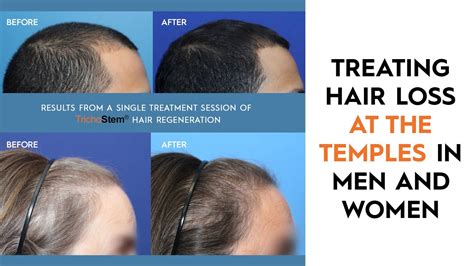 Causes And Treatments For Hair Loss In Temples Youtube