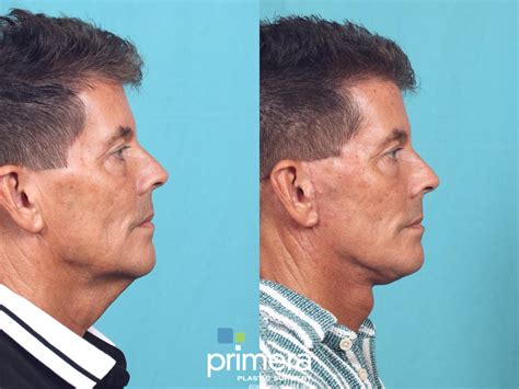 Neck And Face Liposuction Before And After Pictures Case 842 Orlando