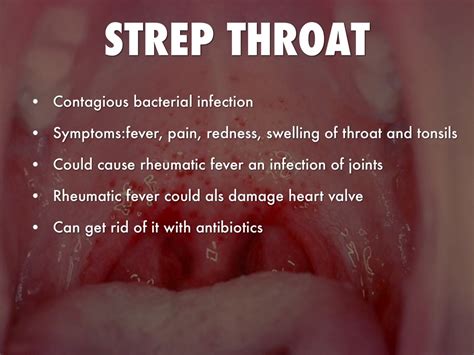 Strep Throat Causes
