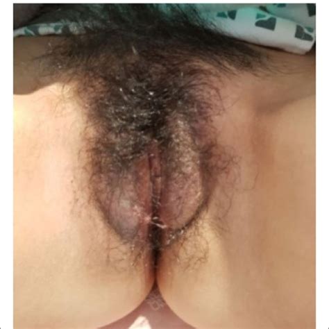 Improvement Of Vulvar Lesion After Medical Treatment Of Crohn S