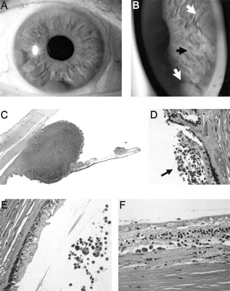 Pars Plana Vitrectomy In Eyes Containing A Treated Posterior Uveal
