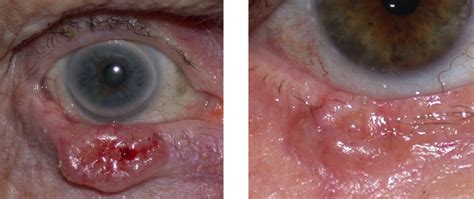 Eyelid Basal Cell Carcinoma Warwar Eye Group