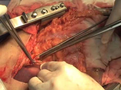 A three stage esophagectomy (mckeown procedure) was performed in a 47 year old male patient with esophageal cancer. Esophagectomy, McKeown Esophagectomy - YouTube