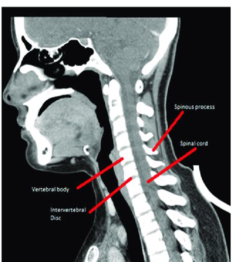 Sagital View Cervical Computed Tomography Download Scientific Diagram