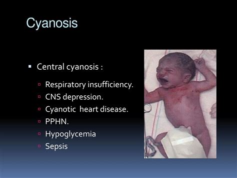 Ppt Common Neonatal Problems Powerpoint Presentation Free Download