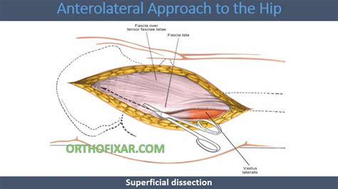 Anterolateral Approach To Hip Joint • Easy Explained • Orthofixar 2023