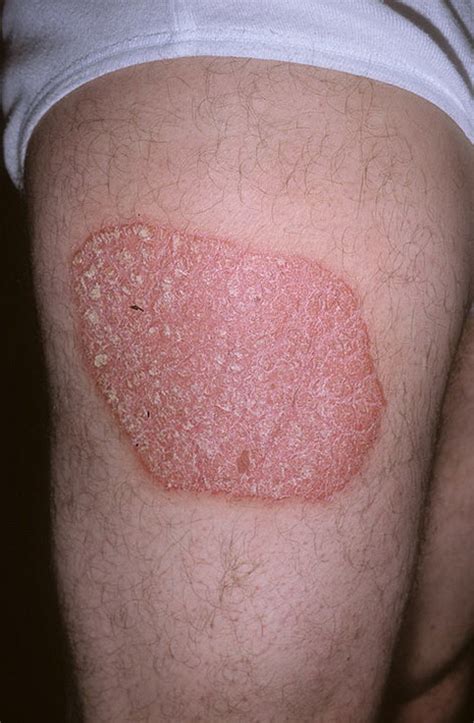 Chronic Plaque Psoriasis Pictures Dorothee Padraig South West Skin Health Care