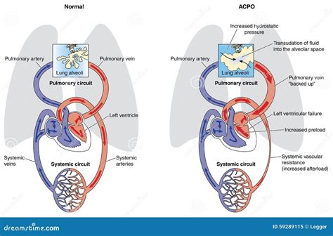 Acute Cardiogenic Pulmonary Oedema Stock Vector Image 59289115