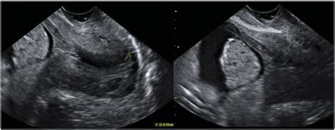 Two Dimensional Transvaginal Ultrasound Showing Amniotic Fluid Sludge
