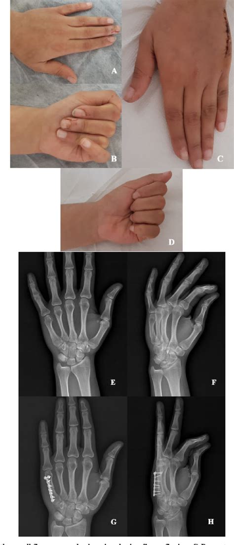 Figure 1 From In Situ Transverse Osteotomy And Locked Mini Plate For