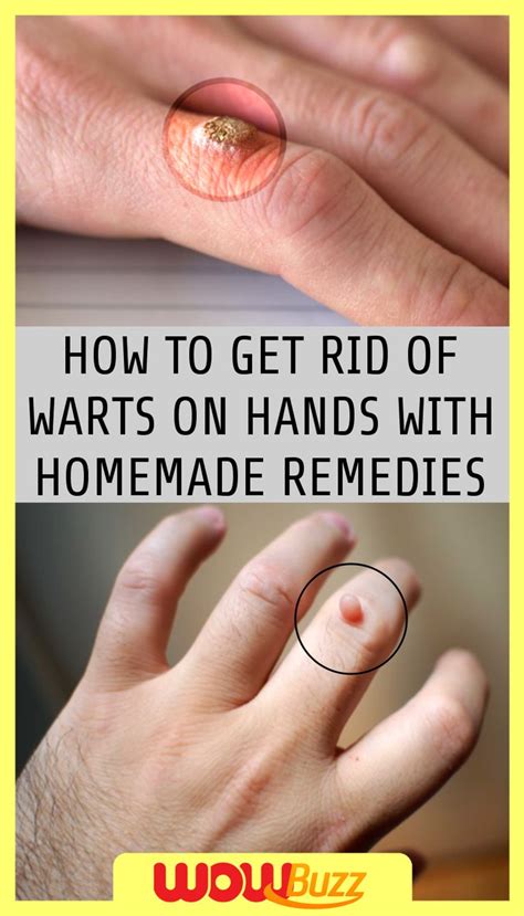 How To Get Rid Of Warts On Hands With Homemade Remedies Warts On