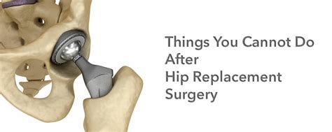 Surgery Hip Replacement