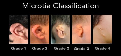 Types Of Microtia Beverly Hills Ca Reinisch Plastic Surgery