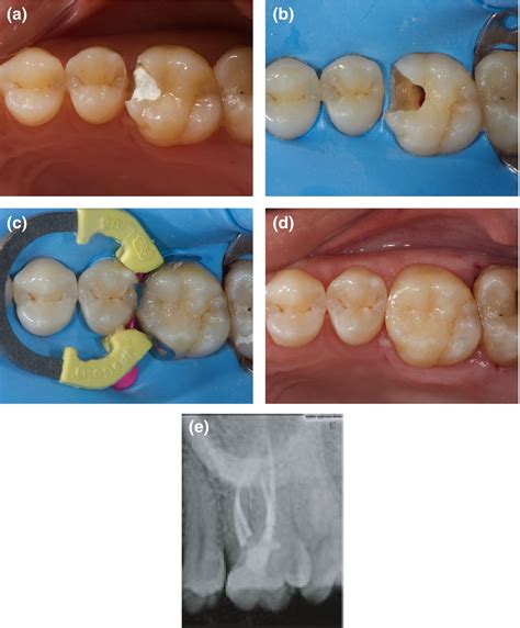 A New Classification System For The Restoration Of Root Filled Teeth