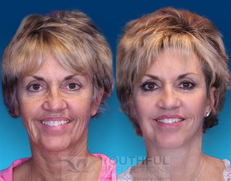 Laser Skin Resurfacing Before And After 022022