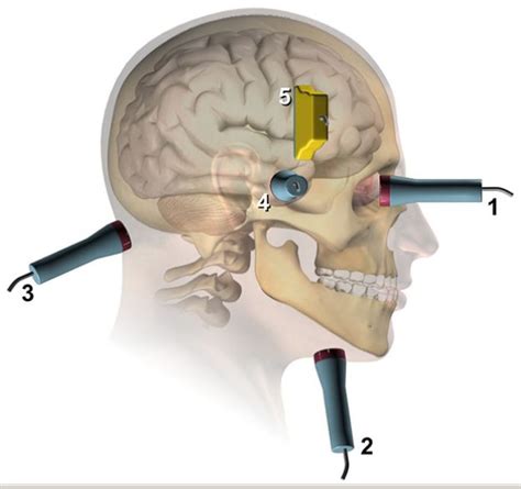 Ultrasonido Transcraneal ADV Medical