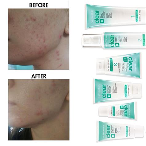 Maybe you would like to learn more about one of these? Before and after using Nutrimetics Clear skincare range ...