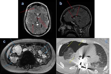 Cureus Myocardial Fatty Foci In Tuberous Sclerosis Complex Imaging