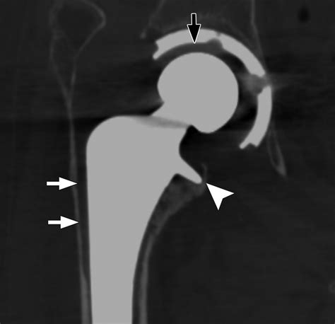 Ct Of The Hip Prosthesis Appearance Of Components Fixation And