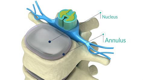 How Long Does It Take To Recover From Annular Tear A Classic Education