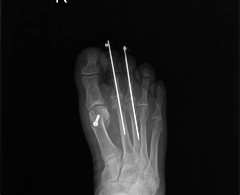 Hammertoe Fixation And Cost Effectiveness What Are The Best Options