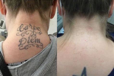 Laser Tattoo Removal Before And After Photo Gallery Chico Yuba City