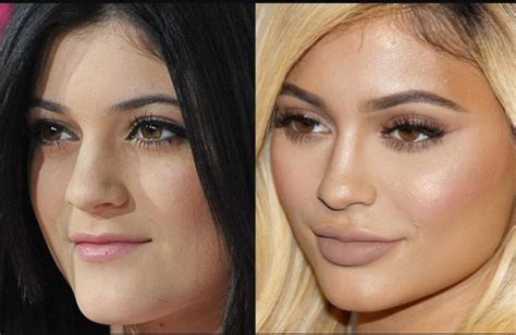 Kylie Jenner Plastic Surgery Nose Plastic Surgery Celebrity Plastic