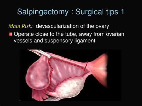 Ppt Update On Reproductive Surgery Powerpoint Presentation Free Download Id4795814