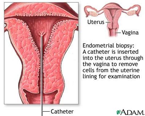 Endometrial Biopsy Medlineplus Medical Encyclopedia Image