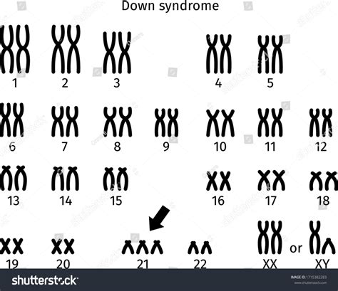 Scheme Of Down Syndrome Karyotype Of Human Royalty Free Stock Vector 1715382283