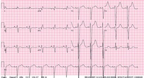 Right axis deviation (rad) involves the direction of depolarisation being distorted to the right (between +90º and +180º). ECG on 4/1/2020 shows NSR, right atrial enlargement, left ...