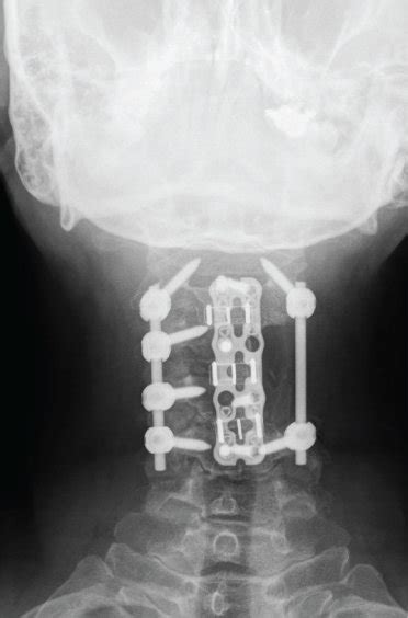 Follow Up A B Ap And Lateral Radiographs Of The Cervical Spine Of