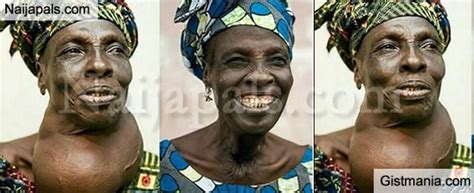 Old Woman In A Happy Mood After Undergoing Successful Surgery Of A Huge
