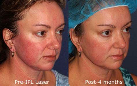 Ipl Photofacial San Diego Ca Cosmetic Laser Dermatology