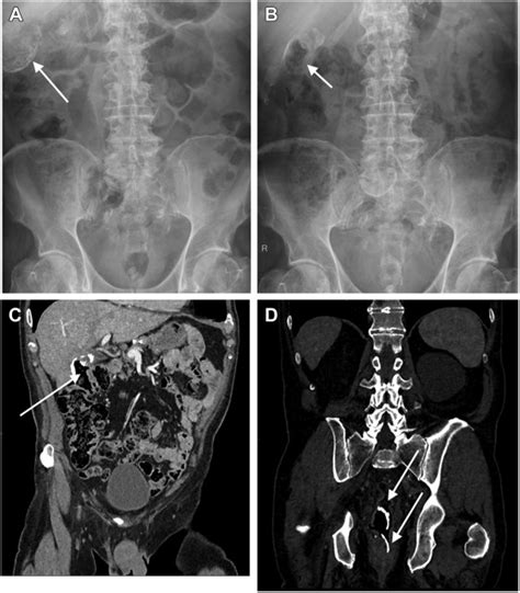 An Unusual Cause Of Rectal Pain Gastroenterology