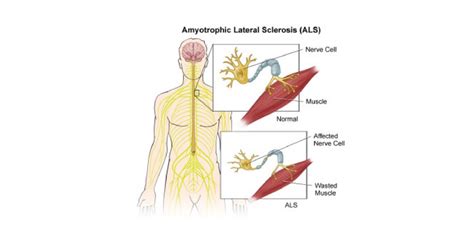 Amyotrophic Lateral Sclerosis Als Nursing Care Plan And Management