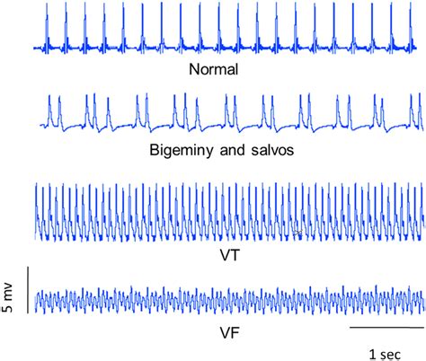 Examples Of Ecg Trace Recordings Bigeminy And Salvos A Variant Of