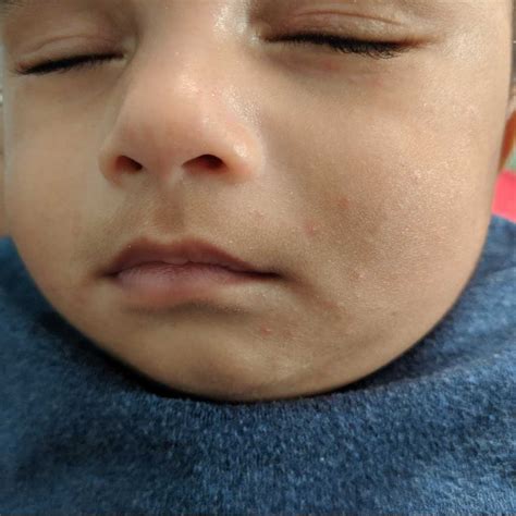 Asktheexpert My Baby Is 12 Days Old After 1 Week Red Pimples Appear