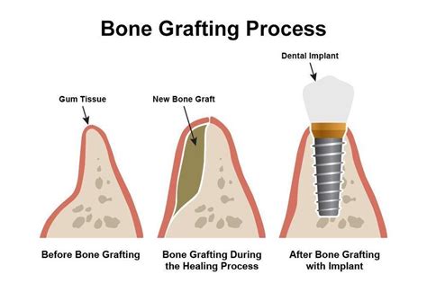 Bone Graft After A Tooth Extraction Methods Healing Process Cost