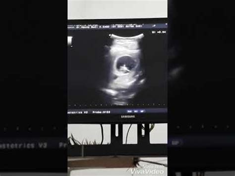USG kehamilan 7 minggu - YouTube