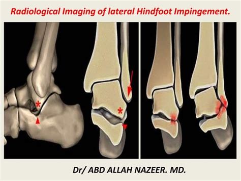 Presentation1 Radiological Imaging Of Tarsal Tunnel Syndrome