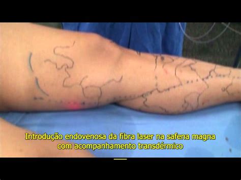 Cirurgia Tratamento De Varizes Laser Dr Eduardo Sisterolli Youtube