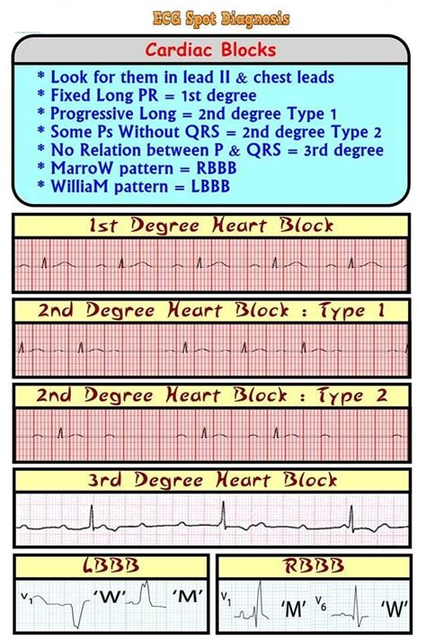 Ecgekg Spot Diagnosis Cardiac Rhythms Heart Blocks
