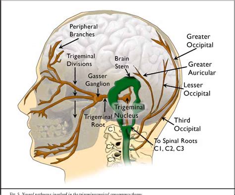 Figure 5 From Prospective Study Occipital Nerve Stimulation For